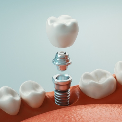 Animated components of a dental implant supported replacement tooth