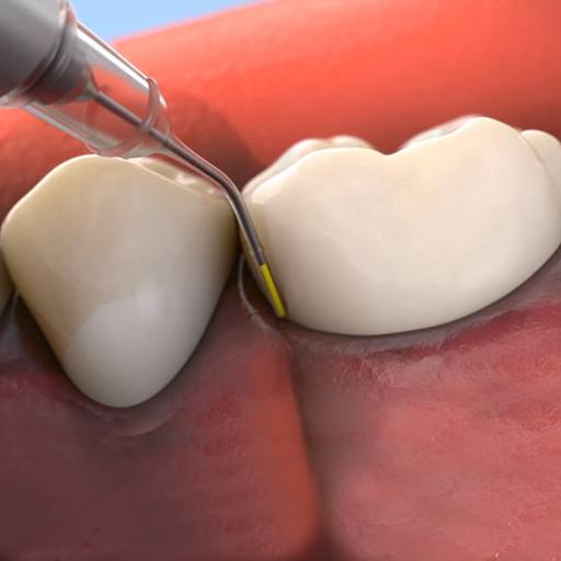 Animated smile during topical antibiotic therapy for gum disease