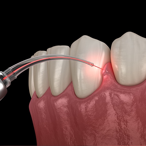 Animated smile during laser periodontal therapy