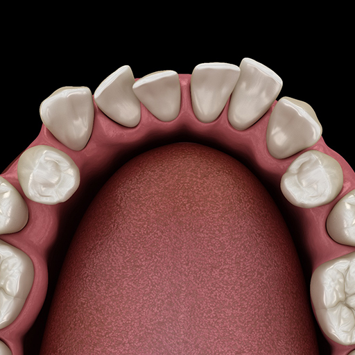 misaligned teeth illustration traditional braces in Winfield 