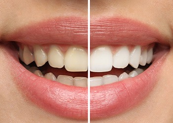 Closeup of patient's smile before and after teeth whitening