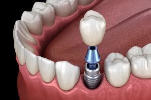 Animated dental implant supported dental crown placement