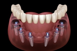 Animated dental implant supported denture placement