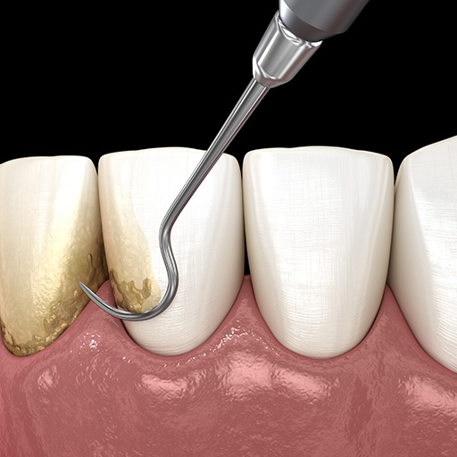 Animated smile receiving scaling and root planing periodontal therapy