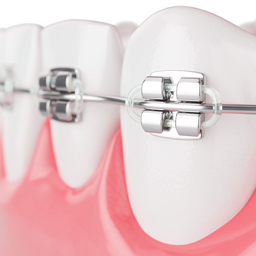 model of traditional braces in Winfield