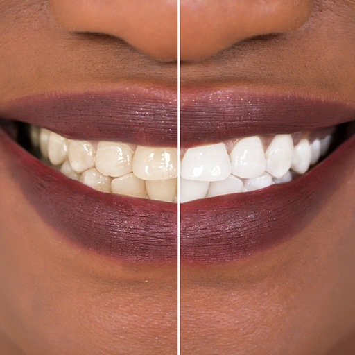 Patient's smile before and after teeth whitening