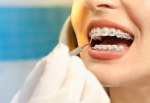 Close up of woman’s braces