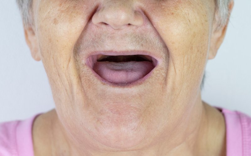 An elderly woman without teeth opening her mouth